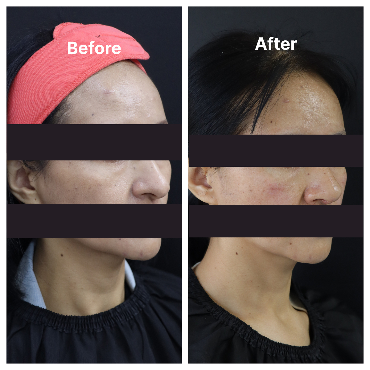 Rhinoplasty result KOQ10